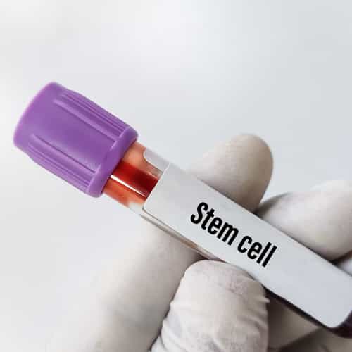 How Much Does Stem Cell Therapy Cost? A Global Comparison of Treatment Prices